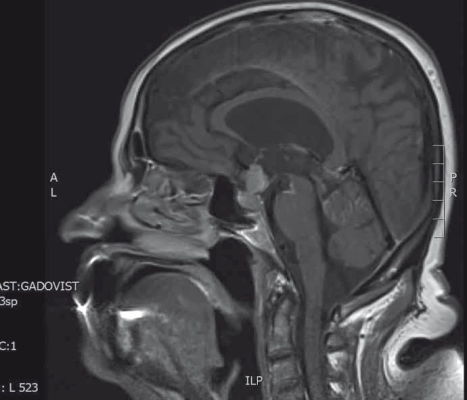 MRI hypofýzy (T1 vážené sagitální skeny s kontrastní látkou).
Selární tumorózní expanze tvaru přesýpacích hodin.