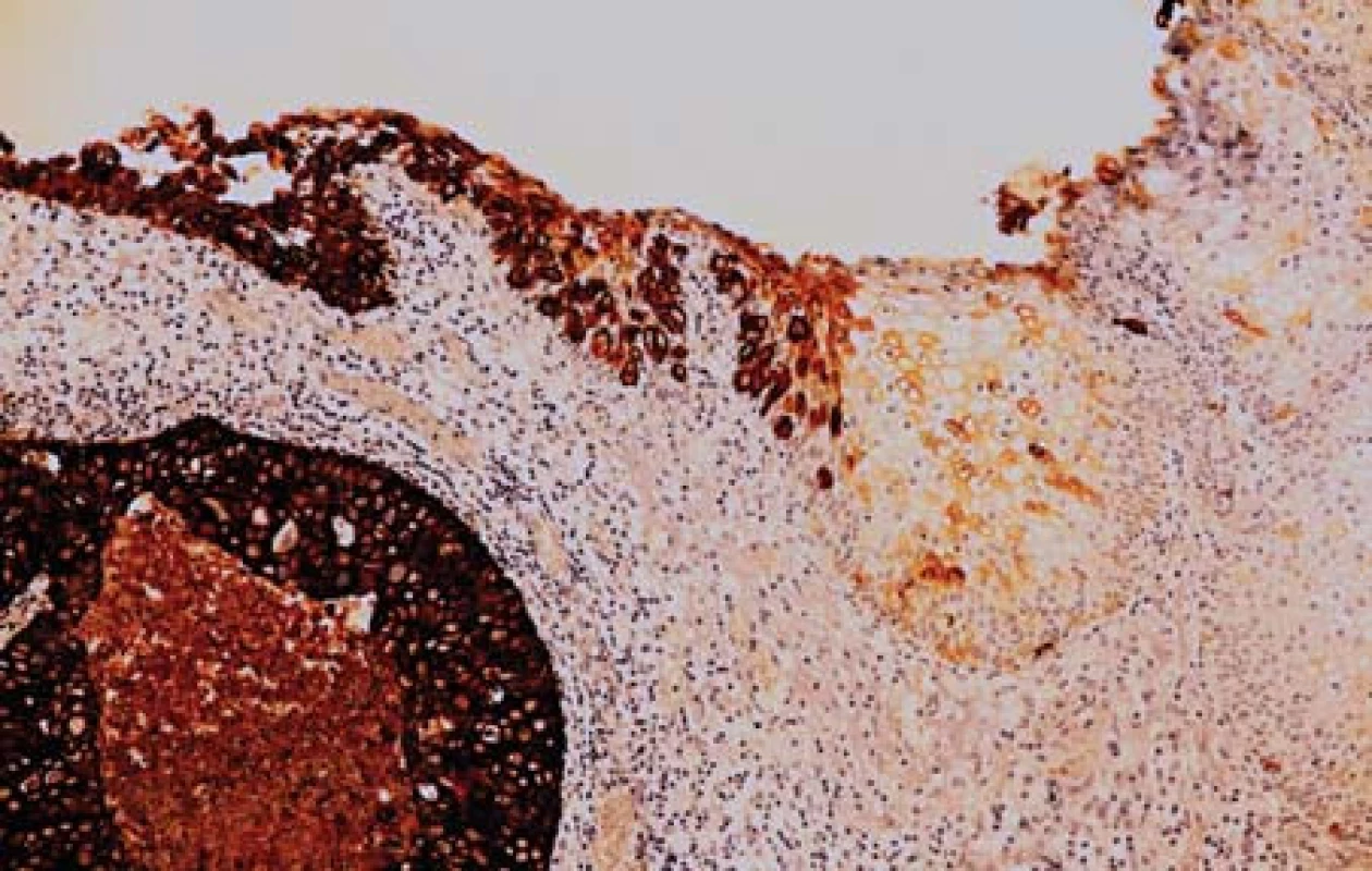 Povrchový epitel močového měchýře reaguje negativně s protilátkou proti CK 7 (v pravé části obrázku) přechází do uroteliálního karcinomu, který je CK 7 pozitivní (imunohistologie, 200x).