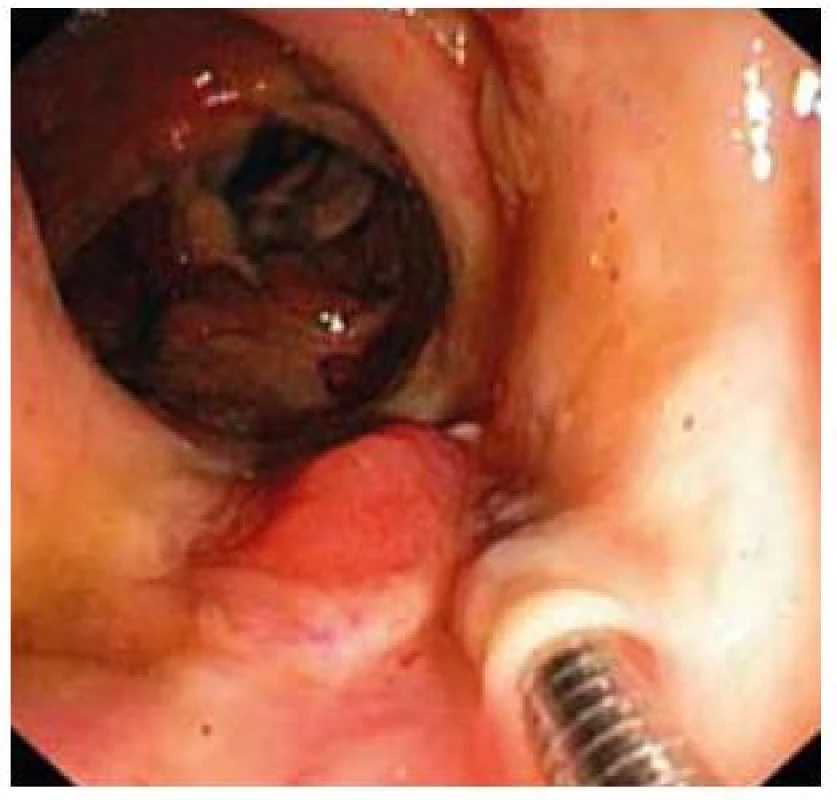 Demarkácia ulcerózne zmenenej sliznice v colon ascendens.
Fig. 6. Flaking of ulcerative mucosa in colon ascendens.
