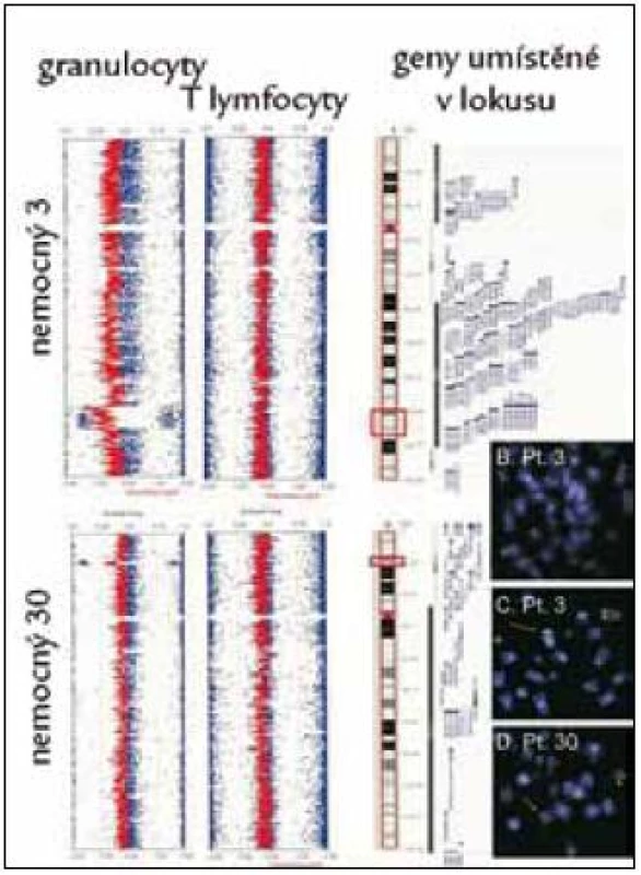 Nález delece v oblasti 5q31.3–q33.2 (nemocný č. 3) a delece v oblasti 12p13.1–p13.2 (nemocný č. 30) pomocí studia variací počtu kopií alel (CNV) v izolovaných populacích granulocytů, nález není přítomen v populace T-lymfocytů, takže se jedná o získanou chromozomální změnu. Nález je ověřen pomocí FISH s lokus specifickou sondou (3 obrázky karyotypů vpravo dole).
