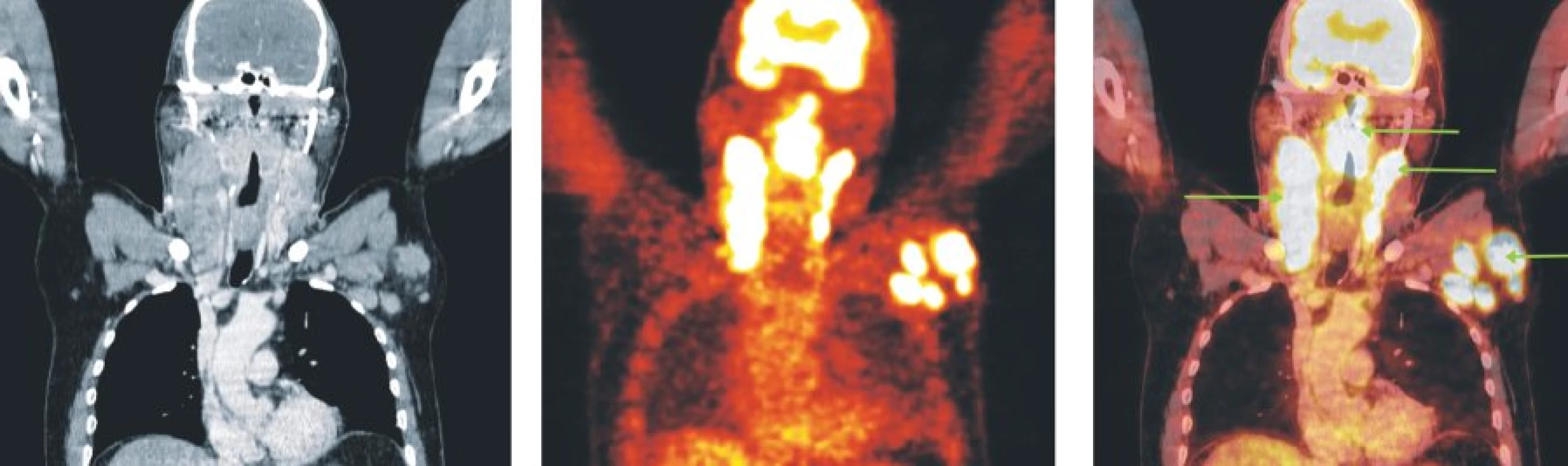 Snímky výpočetní tomografie (CT), pozitronové emisní tomografie (PET) a PET/CT u nemocného s periferním T-buněčným lymfomem. Hypermetabolismus glukózy v oblasti nazofaryngu a orofaryngu, v paketech lymfatických uzlin oboustranně na krku a ve zvětšených lymfatických uzlinách levé axily.