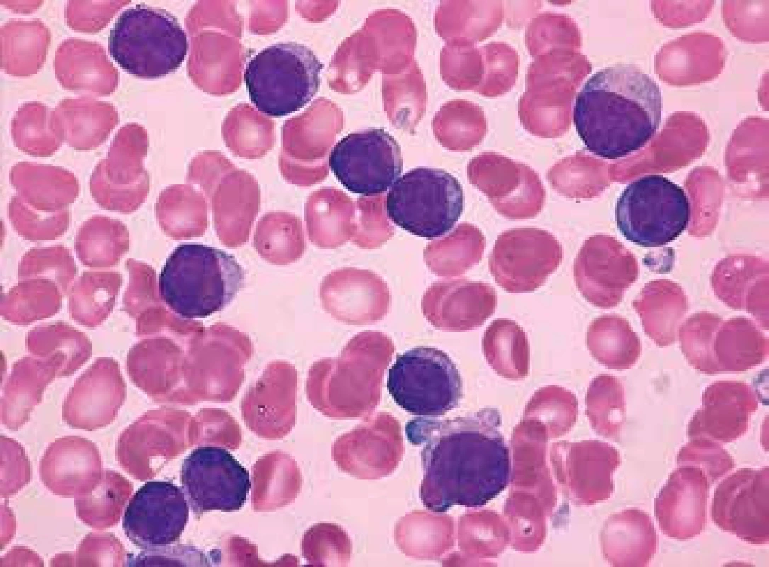 Typická CLL, plazmocelulární diferenciace (malé zralé lymfocyty s různým množstvím bazofilní cytoplazmy a excentricky lokalizovaným jádrem s hutným jaderným chromatinem bez nukleolů), periferní krev, barvení Maye-Grünwalda, Giemsy-Romanowského