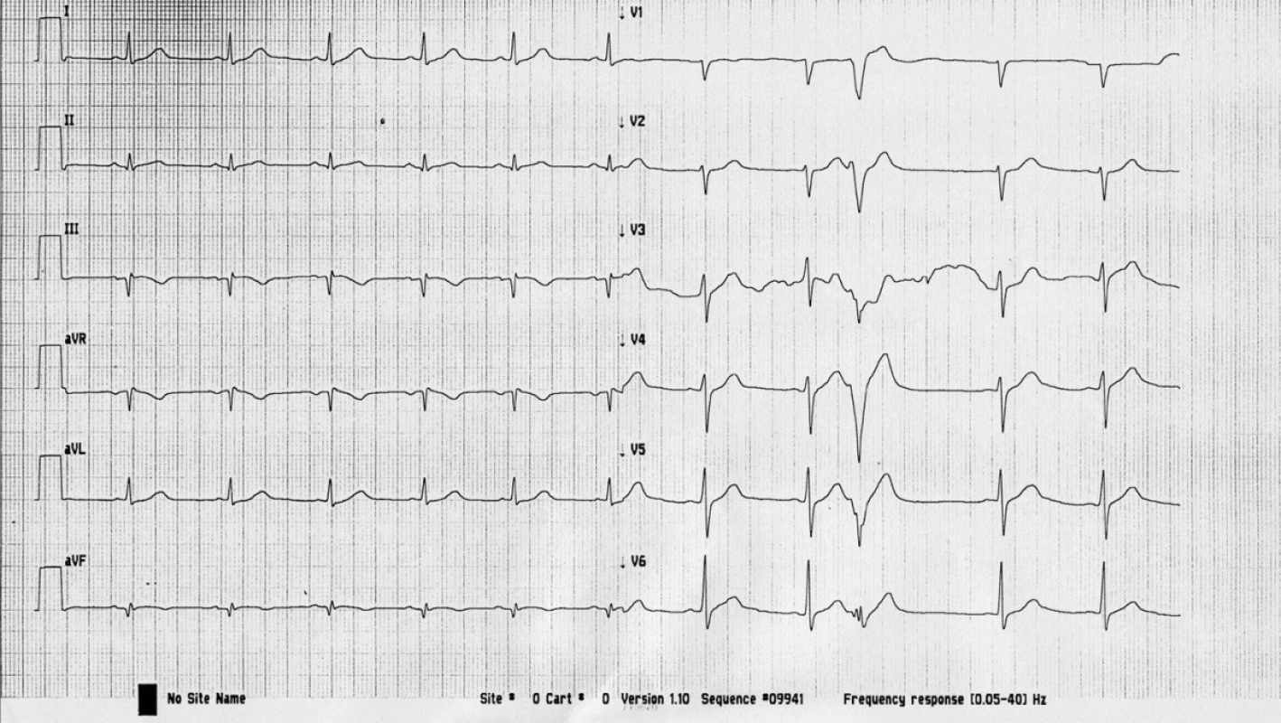 EKG křivka po rekanalizaci pravé koronární tepny