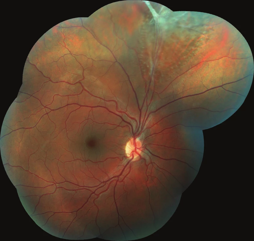 Barevný fotografický snímek fundu pravého oka: sítnice je v horních kvadrantech prořídlá, při horní temporální arkádě jsou pozůstatky perzistující arteria hyaloidea s fibrotickou tkání způsobující lokální retinoschízu staršího data