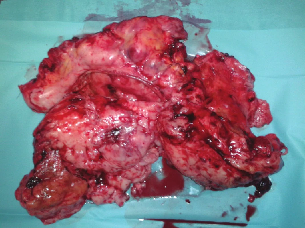 Resekovaná nádorová masa (transversum, žaludek, mesokolon)
Fig. 4: Resected tumor mass (transversum, stomach, mesocolon)