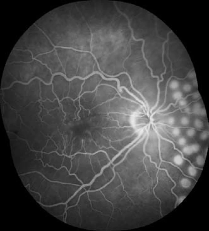 Fluorescenční angiogram v 5. minutě vyšetření, kolem ischemické fovey je rozšířená foveální avaskulární zóna, retinální kapiláry jsou „amputované“ a zakončené fokálními hyperfluorescencemi, v nazálním kvadrantu vidíme fotokoagulační stopy