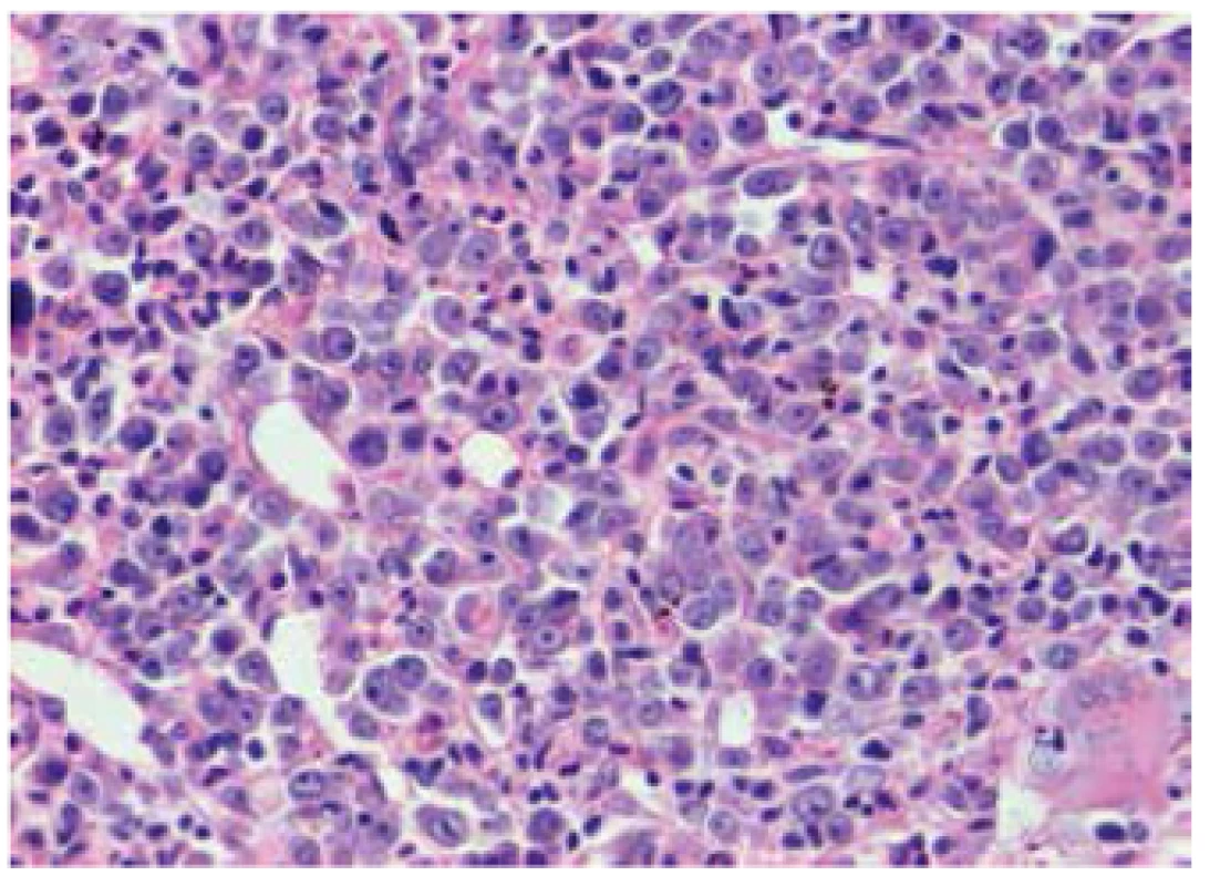 Trepanobioptický nález: obraz těžkých megaloblastoidních změn v červené řadě -prekurzory erytropoézy s výraznými, místy až naznačeně tyčinkovitými jadérky, hematoxilin-eosin, 400x.
