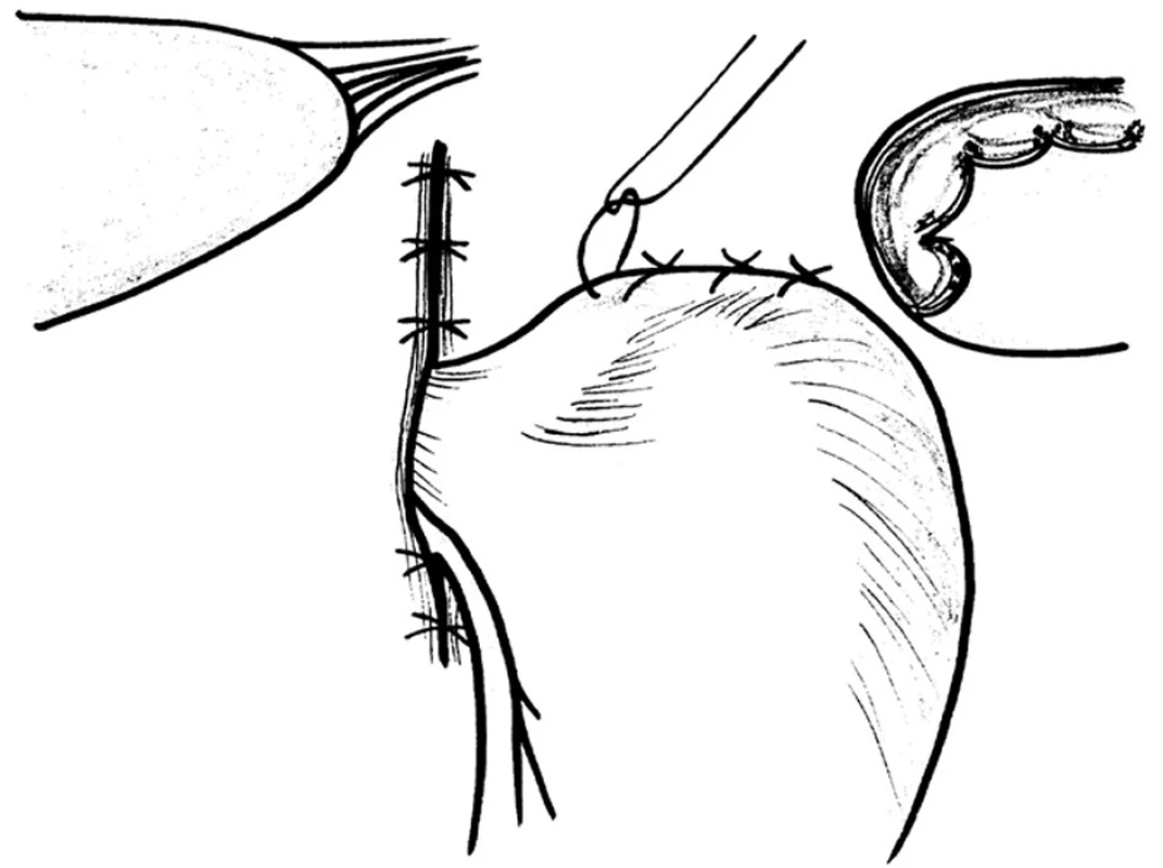 Schéma přední hiátorafie a fundofrenopexe
Fig. 16: Scheme of the anterior hiatorhaphy and fundophrenopexy