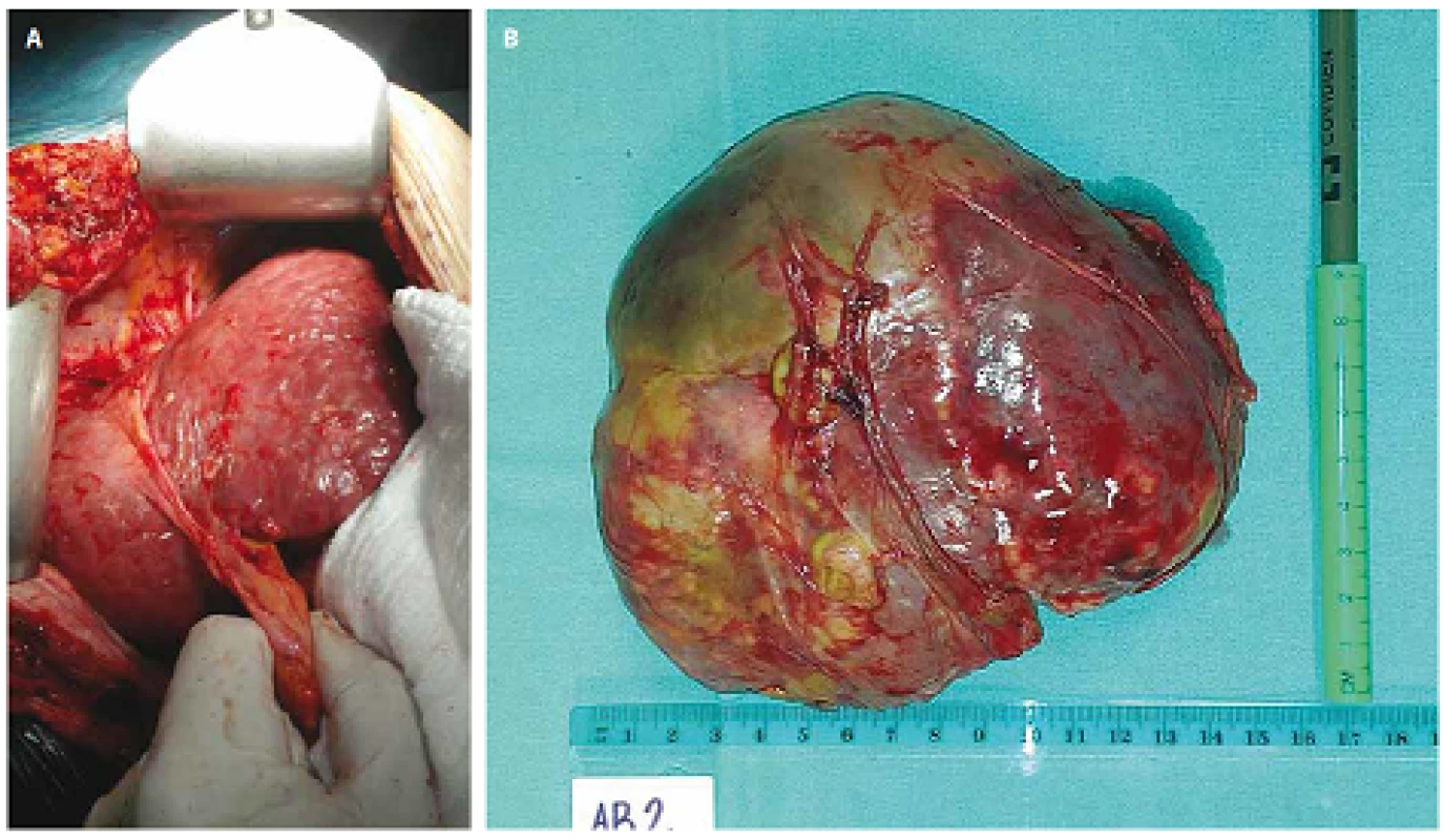 Intraoperative photograph of the hypertrophied left liver lobe (A) and specimen of necrotic right liver lobe after removal (B).