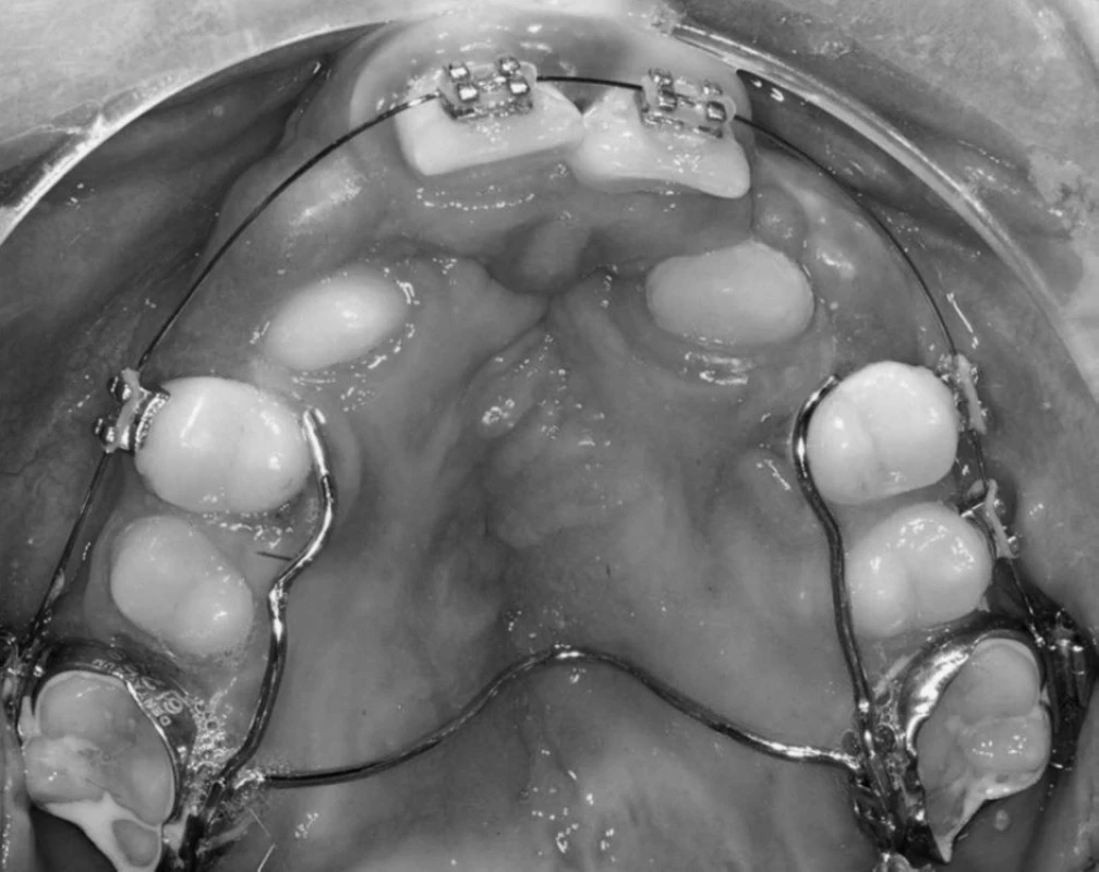 Horní zubní oblouk pacienta pět měsíců po chirurgické rekonstrukci alveolárního výběžku v době prořezávání horních stálých špičáků. Retenční aparát byl sejmut a nahrazen fixním ortodontickým aparátem a transpalatinálním obloukem.