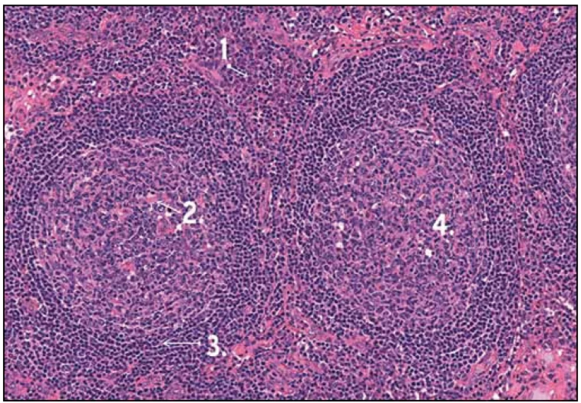 Histologický obraz Castlemanovy nemoci. 1 – infiltráty plazmatických buněk, 2 – depozitum fibrinu v germinativním centru, 3 – typické pravidelné uspořádání plášťové zóny, 4 – germinativní centra bez hyalinních změn. 