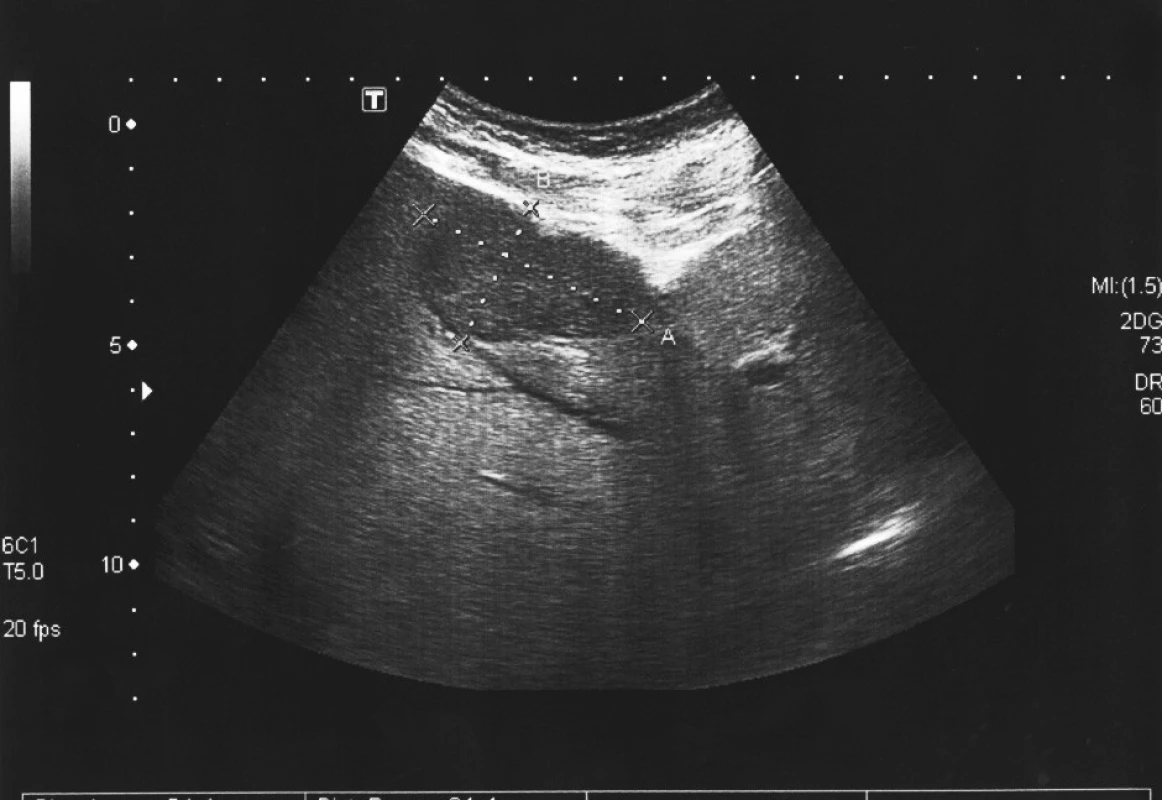UZ jater s metastázou
Fig. 3. Liver ultrasound with a metastasis