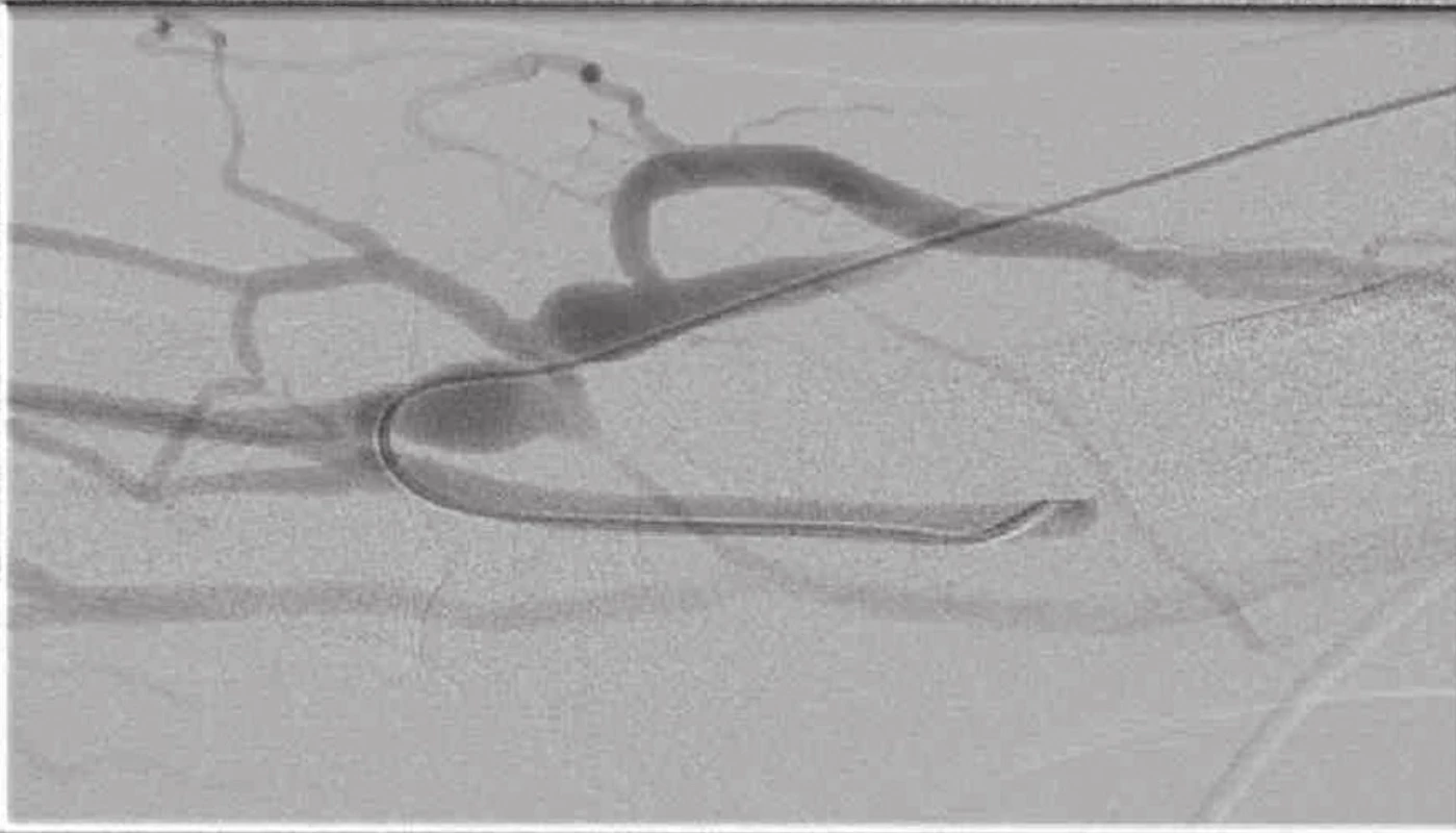 Fistulografie s těsnou stenózou na odvodné žíle a přítomnými kolaterálami
Fig. 9: Fistulogram showing a tight stenosis in the main vein and the presence of collateral veins