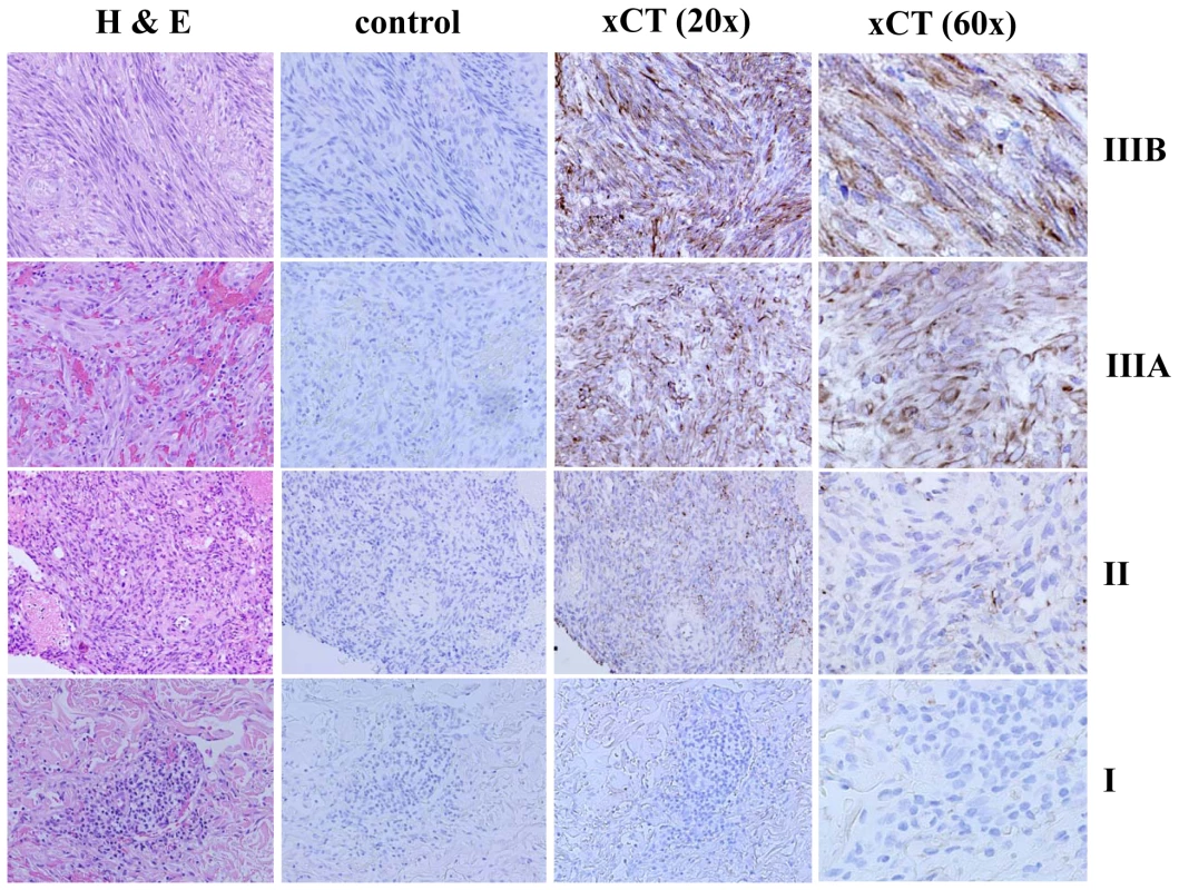 xCT expression within KS lesions correlates with tumor stage.