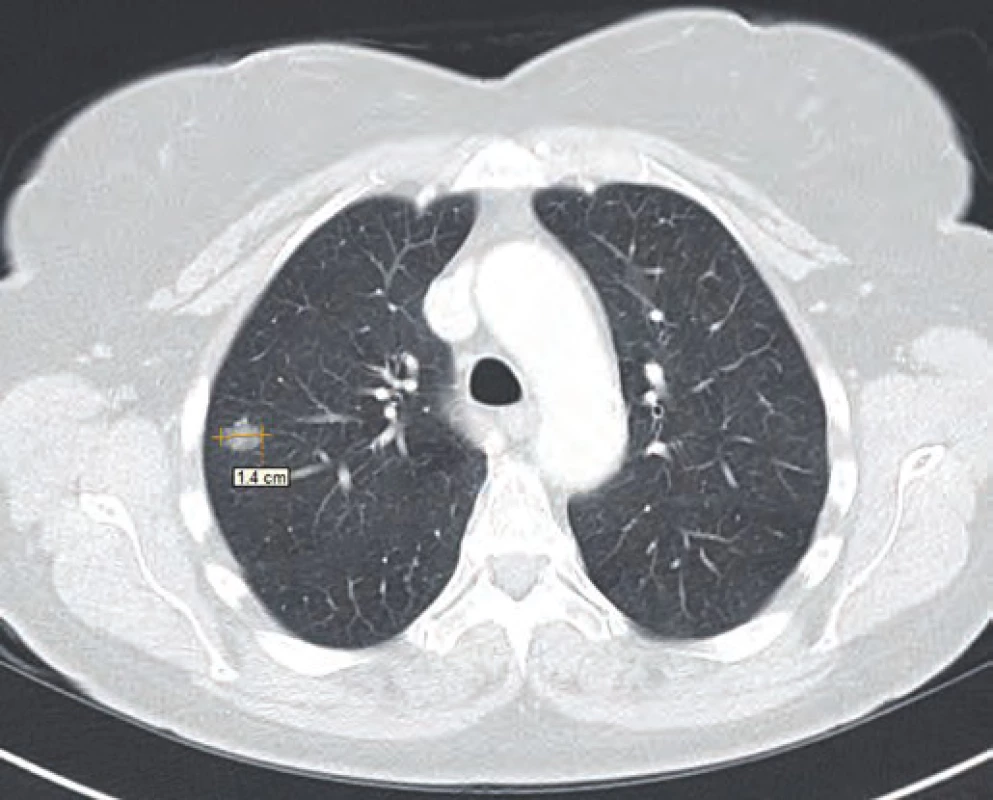 CT řez plic z února 2015.