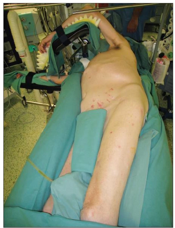 Poloha pacienta při operaci TAAA
Fig. 2. Patient position during TAAA procedure