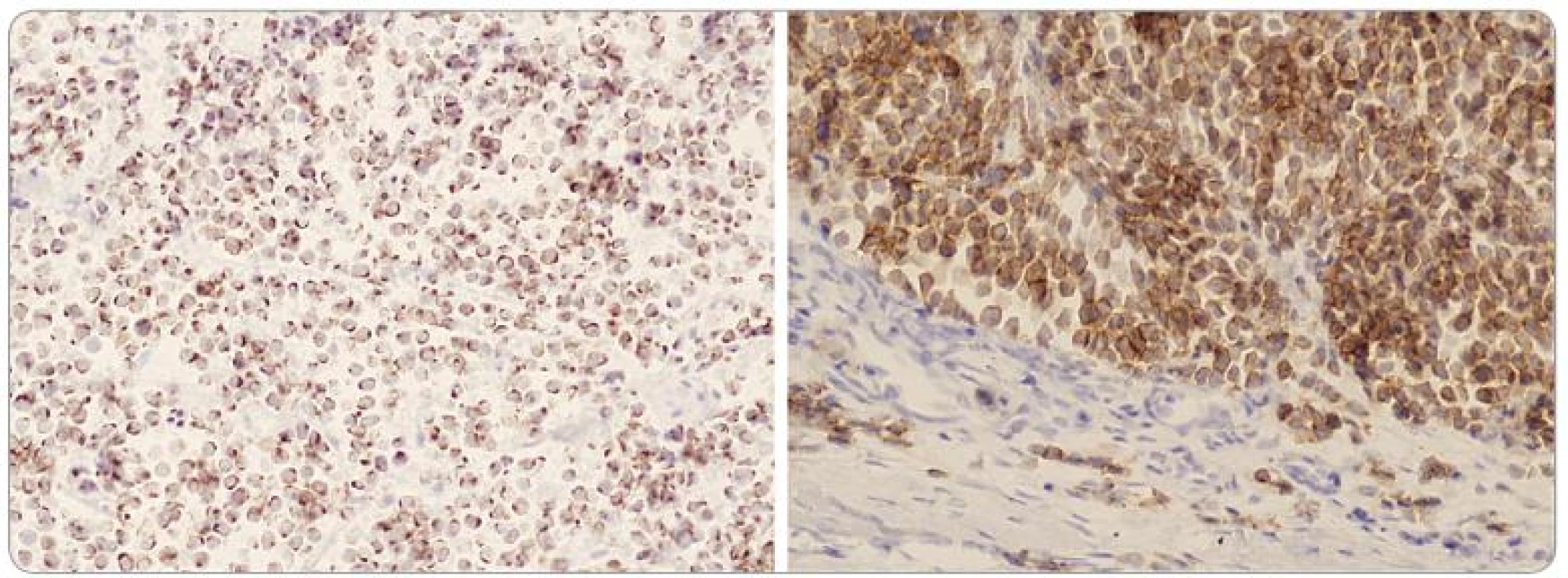 Buňky tumoru s výraznou dot-like paranukleární pozitivitou cytokeratinu 20 (vlevo, x 200) a membránovou pozitivitou CD 56 (vpravo, x 200).