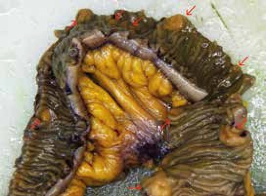Specimen of ileum after fixation in formaldehyde.
Lesions of NET marked by arrows
