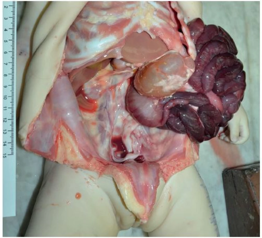 Nález v dutině břišní u 5,5měsíční dívky. Volvulus celého tenkého střeva a vzestupného tračníku se strangulací a s hemoragickou infarzací střevní stěny. Není přítomen obvyklý široký úpon mezenteria k zadní stěně dutiny břišní, probíhající od duodenojejunální junkce do pravého dolního kvadrantu dutiny břišní. Závěs tenkého střeva je úzký, společný s volným mesocolon vzestupného tračníku – mesenterium commune.