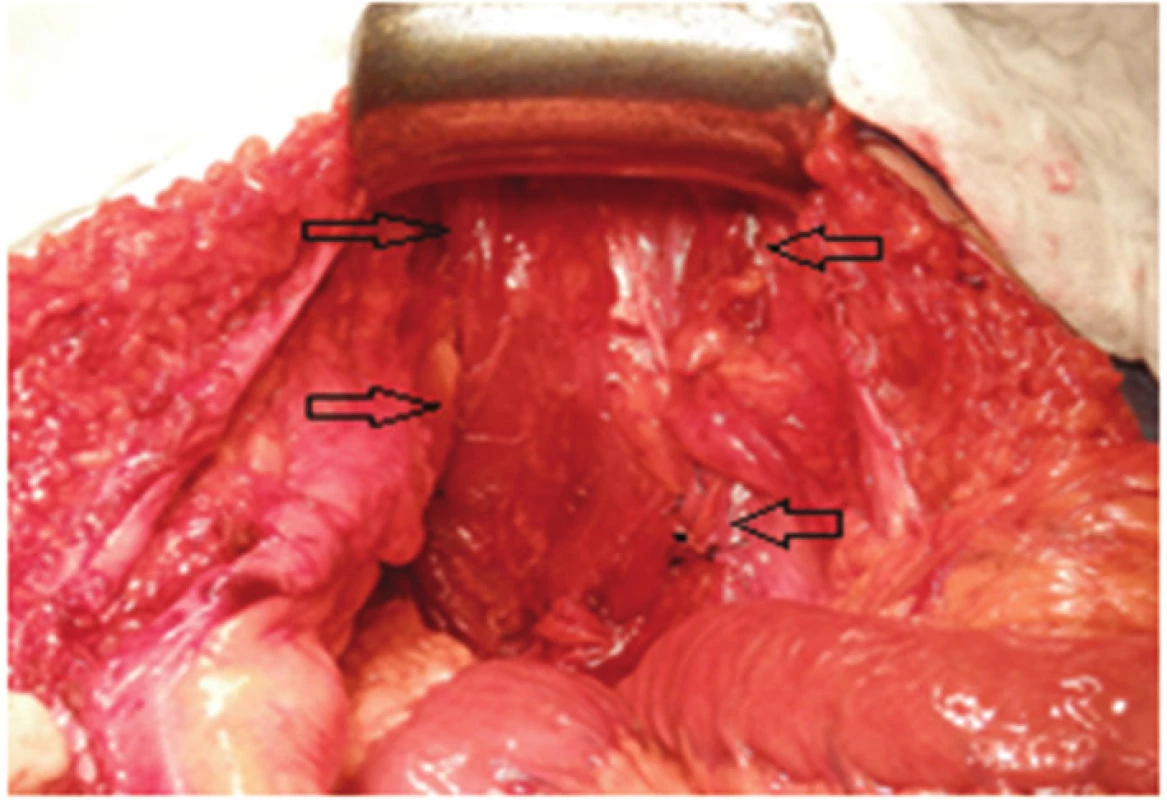 Pánevní vchod je zcela vyplněn svalovým lalokem
Fig. 7: Pelvic inlet filled completely by the muscle flap