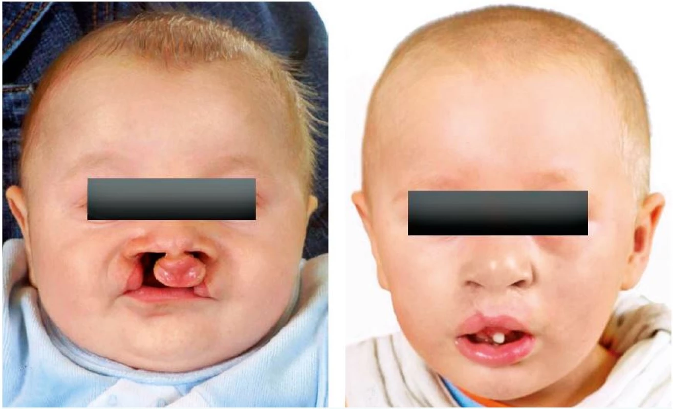 A, B. The face of the patient before primary surgical correction of the lip at the age of five months and before palate reconstruction in 22 months