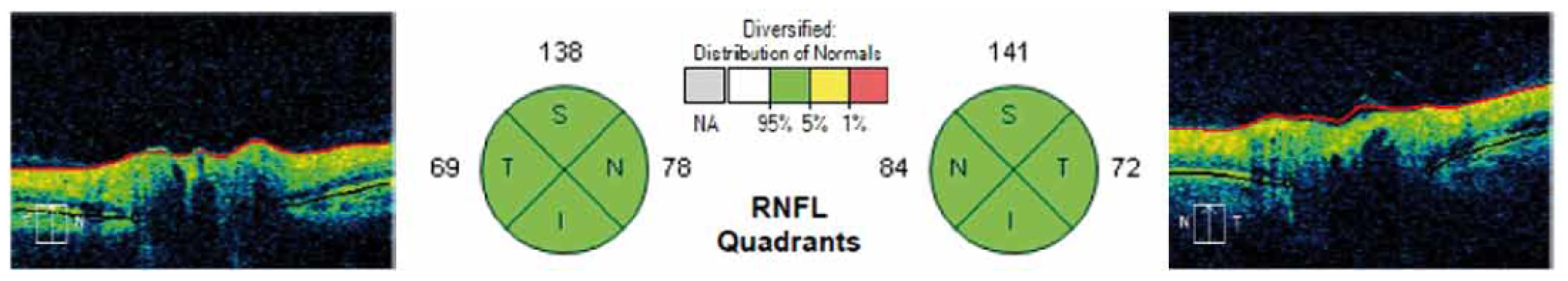 Grafické znázornění výsledků měření RNFL v jednotlivých kvadrantech kolem terče zrakového nervu na sítnici.
V kruzích na obrázku jsou znázorněny jednotlivé kvadranty (S – horní (v tabulce H), I – dolní (v tabulce D), T – temporální, N – nazální) a číselné hodnoty měření RNFL u jednoho z pacientů.
Fig. 2. Graphical representation of measurement results for each quadrant RNFL around the optic nerve in the retina.
The circles in the figure show the individual quadrants (S – upper (H in table), I – lower (D in table), T – temporal, N – nasal) and numerical values for RNFL measurement in one of the patients.