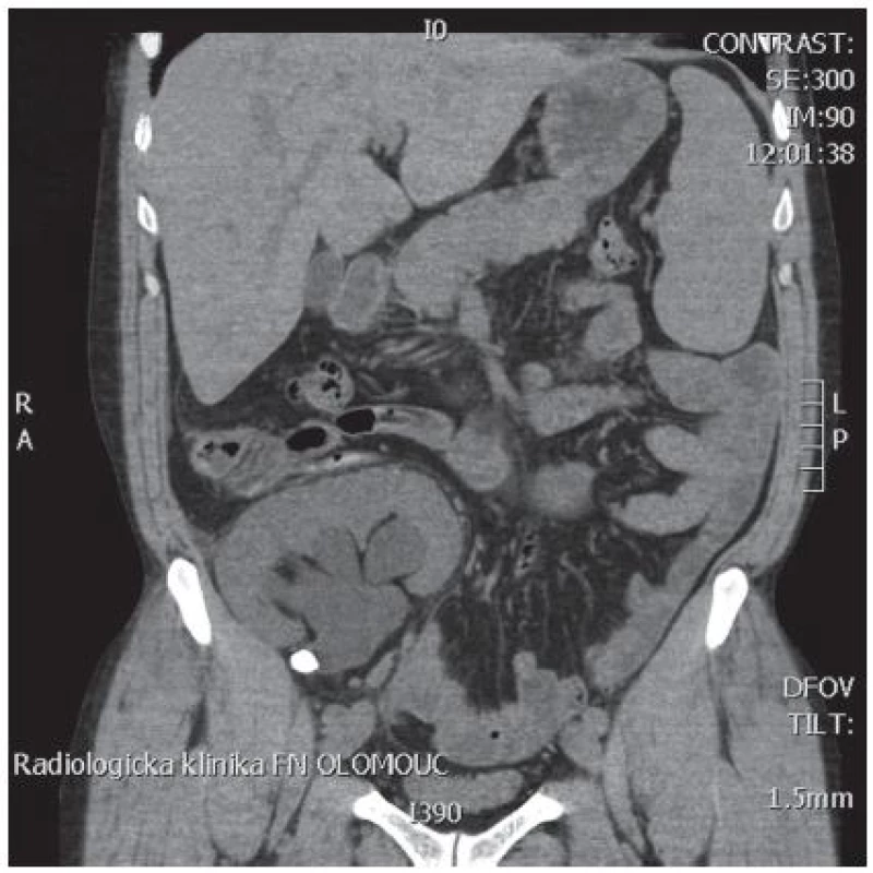 Nativní spirální CT transplantované ledviny s litiázou v pelviureterální junkci
Fig. 1. Native spiral CT scan of tranplanted kidney with stone in ureteropelvic junction