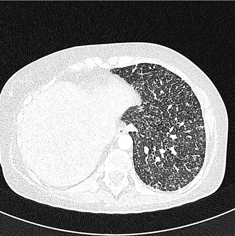 HRCT hrudníku u téže nemocné – diseminace mikronodulárních denzit v levé plíci