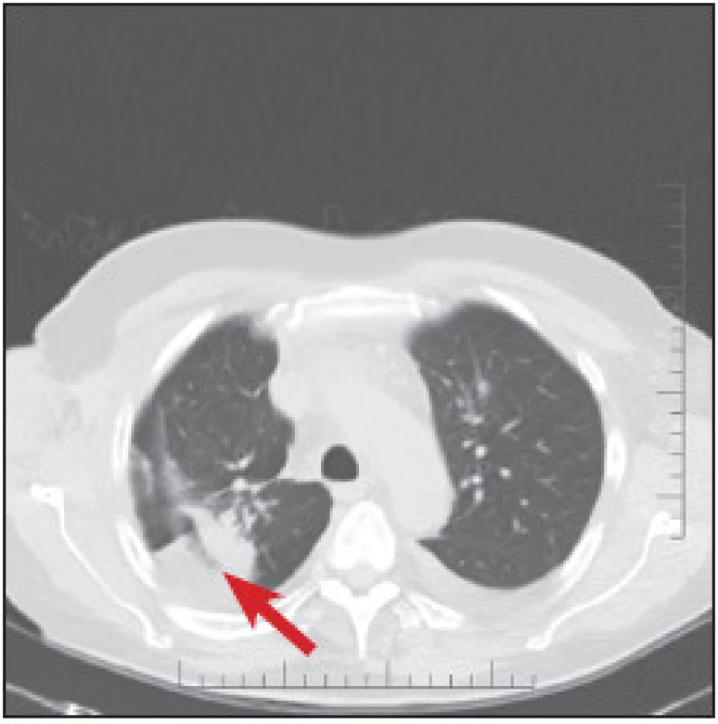 CT plic z března 2011. Hyperdenzní ložisko v pravé plíci popsáno jako tumor.
