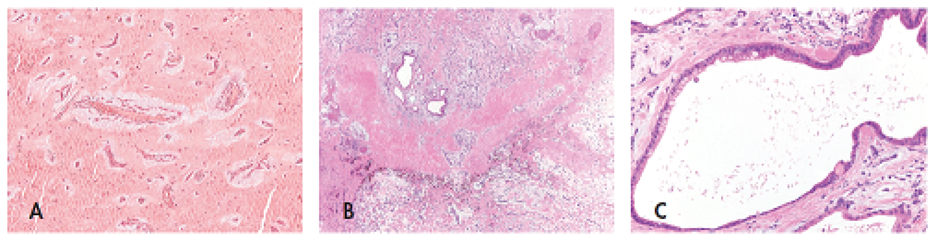 Srdeční myxom tvořený kulatými, polygonálními a cípatými buňkami hojně obklopenými stromatem bohatým na mukopolysacharidy a rostoucími kolem cévních struktur (A, zvětšení 200x); velmi vzácně může být u CNC součástí srdečního myxomu glandulární komponenta s typickým kolumnarním žlazovým epitelem s pohárkovými buňkami (B, zvětšení 40x; C, zvětšení 200x). Barveno hematoxylinem eozinem.