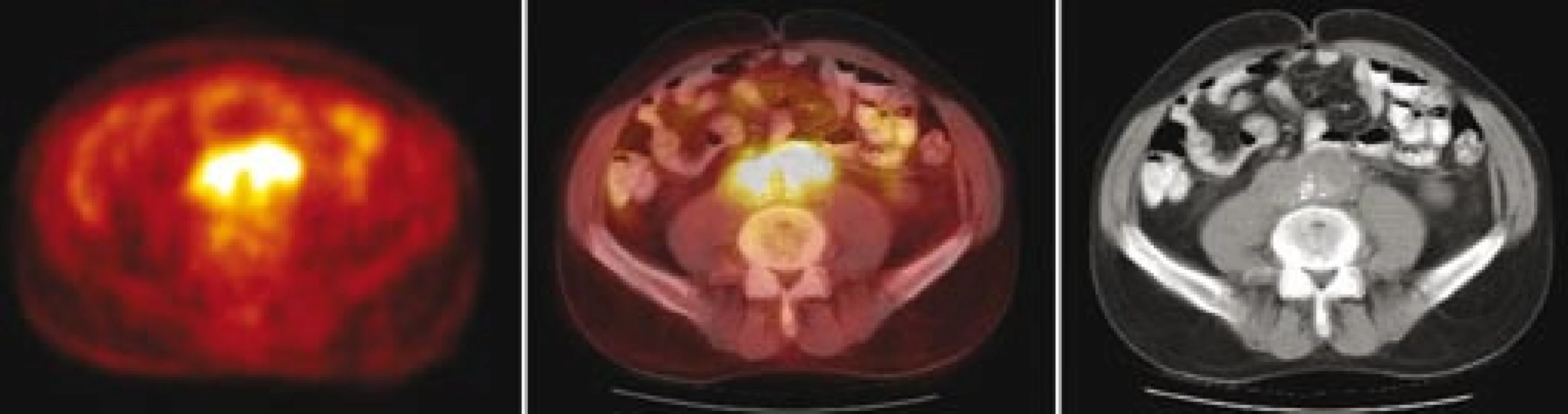 Fúze PET/ CT – transverzální řezy ve výši bifurkace aorty: vlevo obraz PET v barevné škále hot body, uprostřed fúzovaný obraz 50 % PET a 50 % CT, vpravo CT. Je patrná korelace metabolicky aktivní tkáně (PET) a lemu měkkotkáňových struktur kolem břišní aorty (CT).