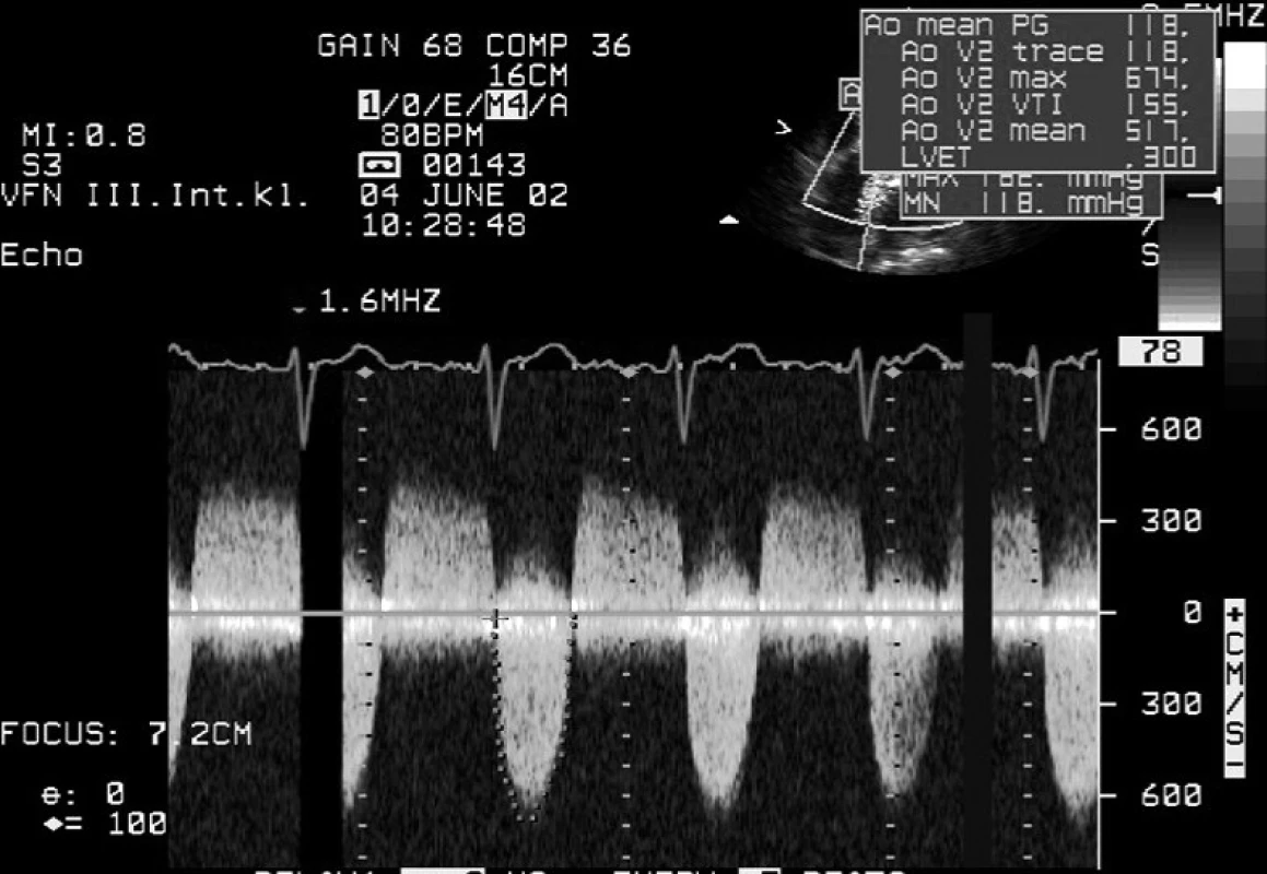 Kontinuální dopplerovská echokardiografie – rychlosti krevního proudění na bikuspidální aortální chlopni s doprovodnou kombinovanou aortální vadou Zachycený maximální tlakový gradient činí u aortální stenózy 182 mm Hg, střední gradient 118 mm Hg.