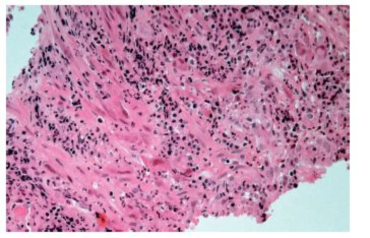 Cytomegalovirová ezofagitida. Charakteristické intranukleární eozinofilní (modrá šipka) a méně nápadné intracytoplazmatické bazofilní inkluze se nacházejí zejména 
v endoteliích, myofibroblastech a makrofázích ve spodině ulcerací (HE, 800x).