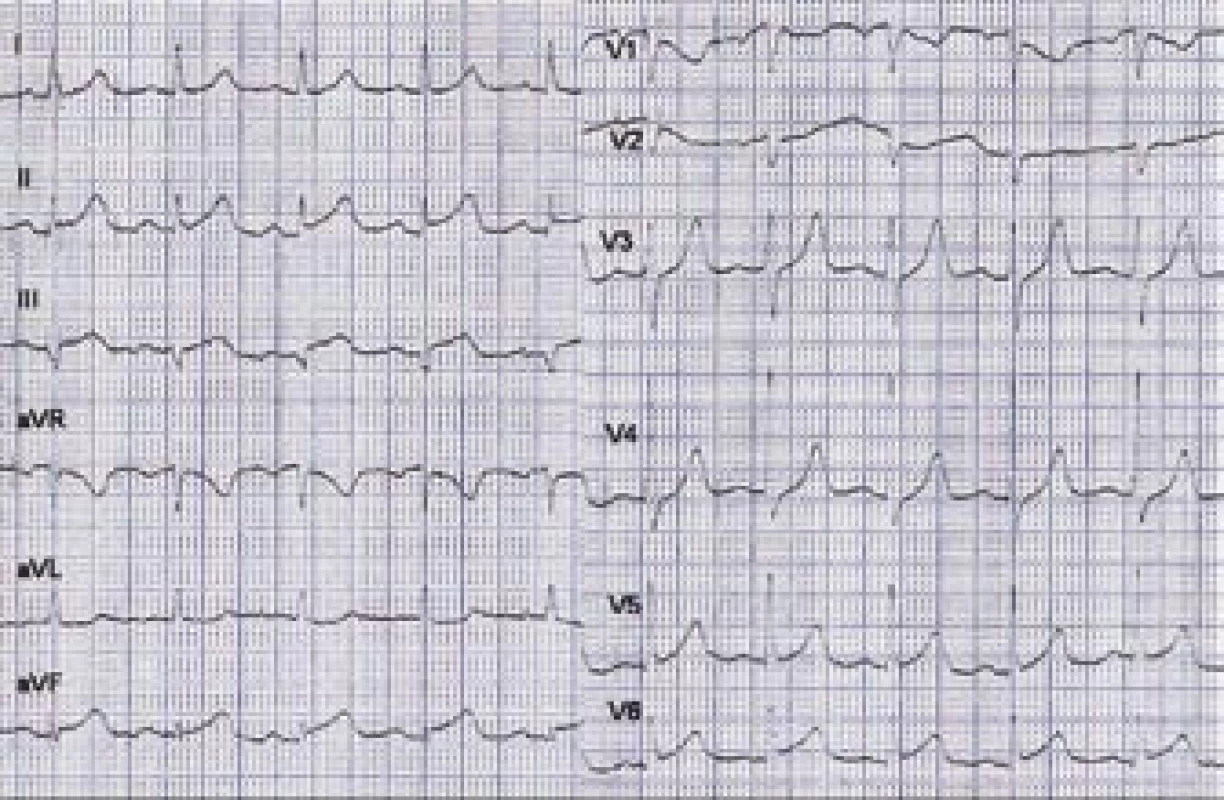 Vstupní EKG – obraz STEMI inferolaterálně.