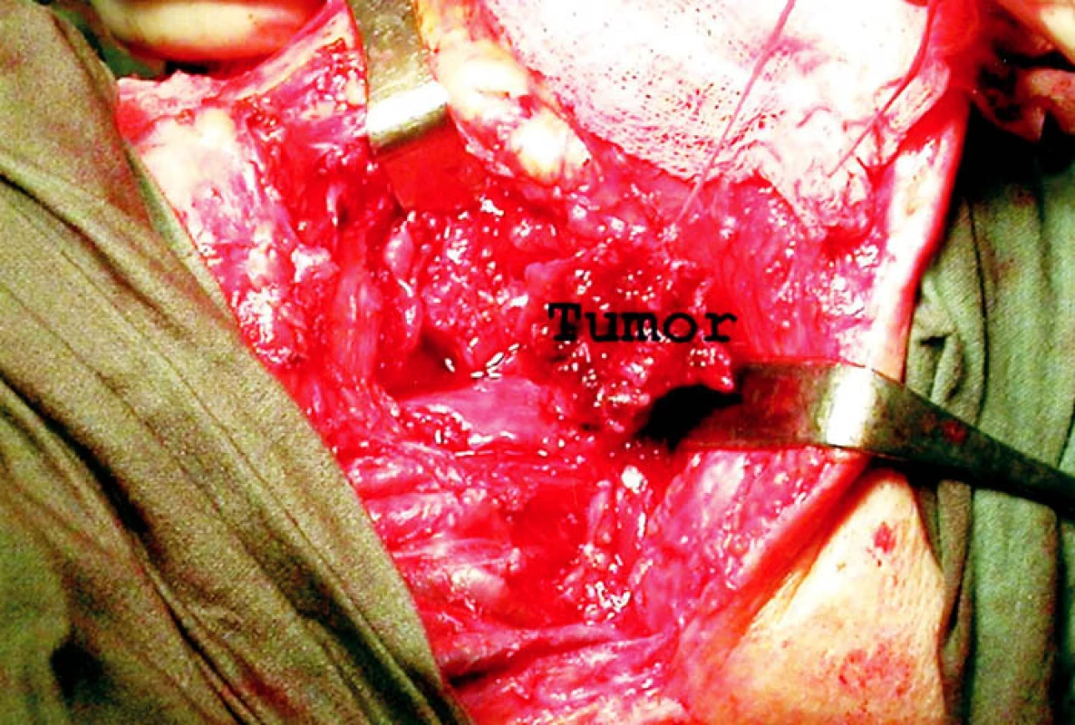 Pohled z levé strany otvorem po laterální faryngotomii. Tumor boční stěny hypofaryngu je v hloubi operačního pole poněkud posunut do strany.