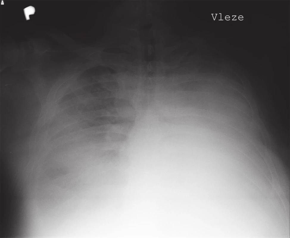 Prostý snímek hrudníku vleže zobrazující zastřený levý hemitorax
Fig. 1: Plain chest x-ray in supine position showing a blurred left hemithorax