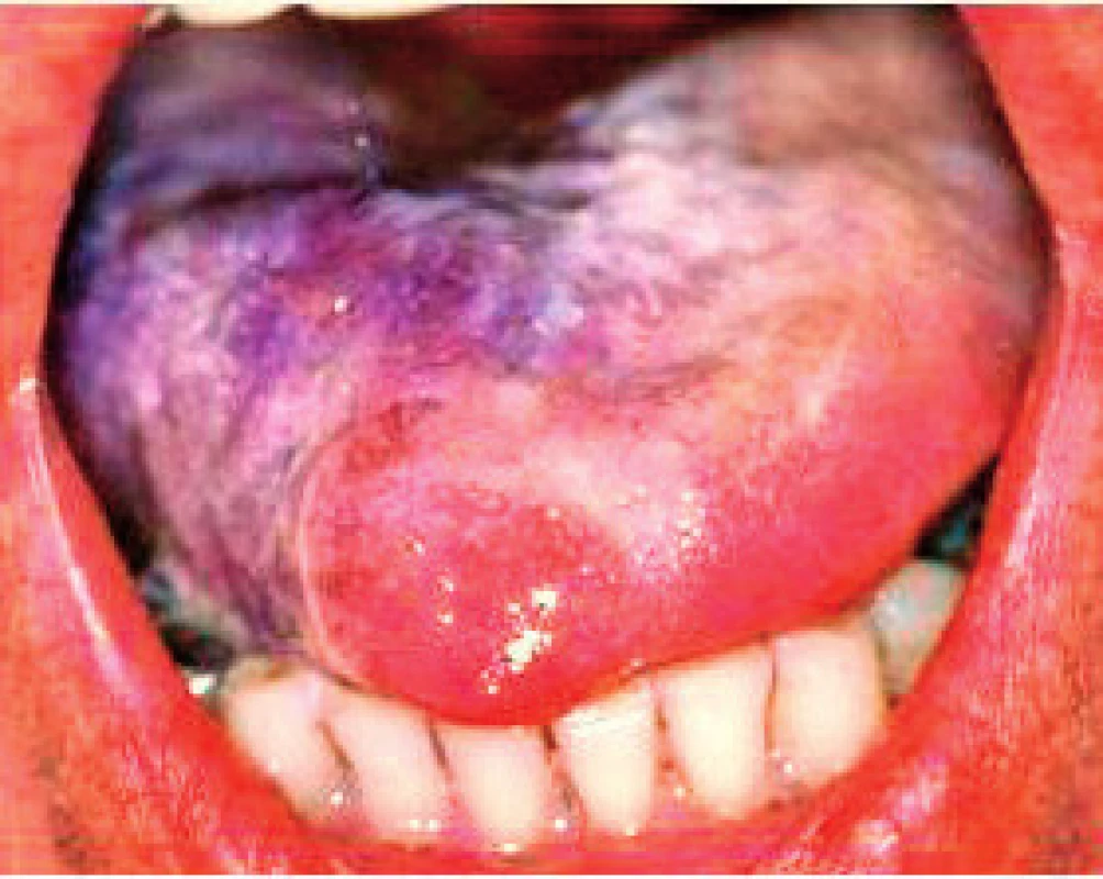 Pseudomembranózna forma orálnej kandidózy na povrchu jazyka. Vrstva kultúr kandíd má tendenciu postupne sa olupovať (Ďurovič)