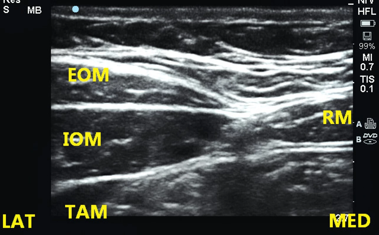 Ultrazvuková anatomie pod úrovní pupku
EOM – m. obliquus abdominis externus, IOM – m. obliquus abdominis internus, TAM – m. transversus abdominis, RM – m. rectus abdominis