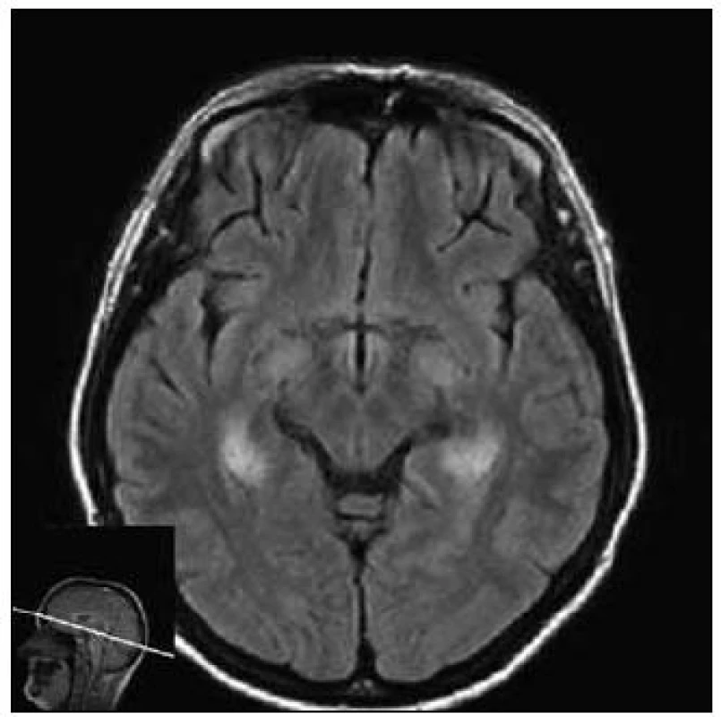 MR mozku – diskrétní zvýšení signálu ve FLAIR (axiální řez) v oblasti mediálních temporálních laloků oboustranně u 1. případu.