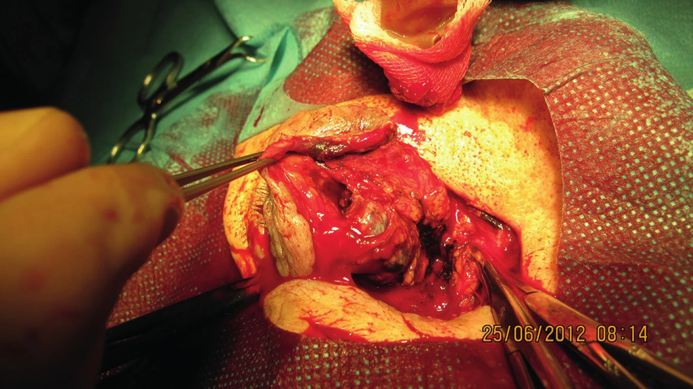 Peroperačný nález počas exenterácie očnice (6/2012)