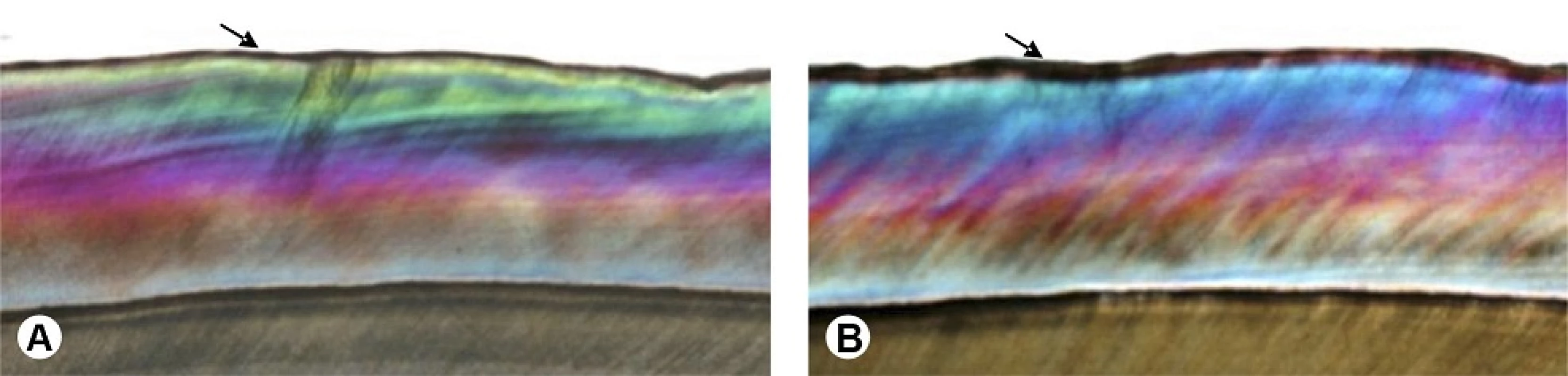 Polarized light microscopy analysis. Image obtained by polarized light microscopy (25×). A: Specimen subjected to cariogenic challenge. Uniform demineralization of the enamel surface (arrow) may be observed. B: Group II specimen subjected to cariogenic challenge and bleaching procedure, arrow indicates a thicker area of negative birefringence, to an average depth of up to 83 μm, without apparent cavitation.