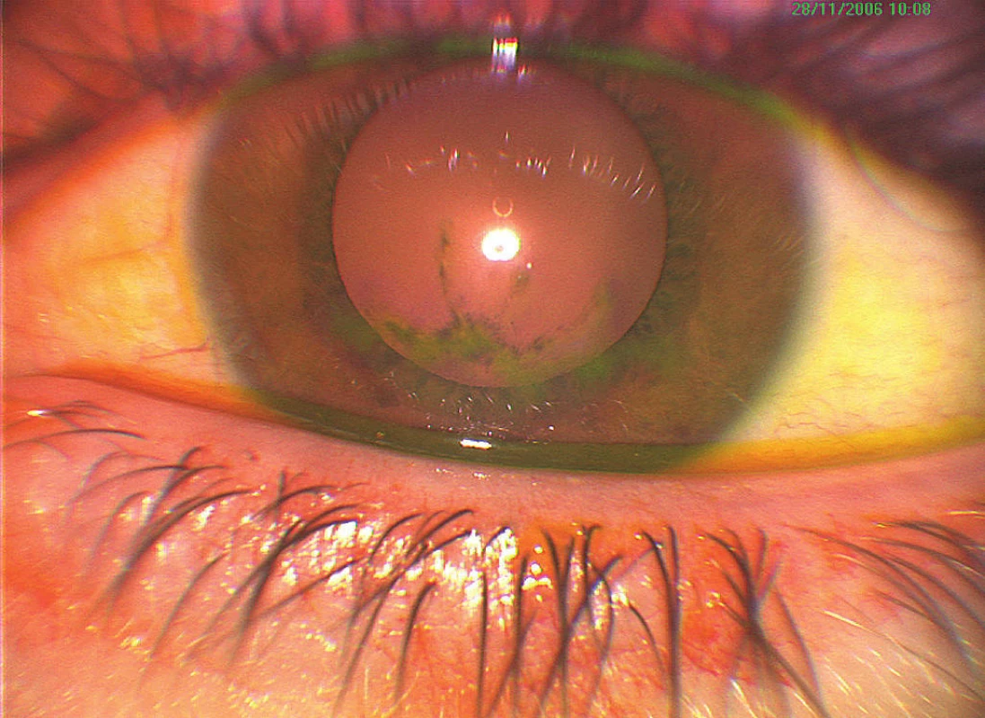 Nález keratitídy na ľavom oku pri prvom vyšetrení