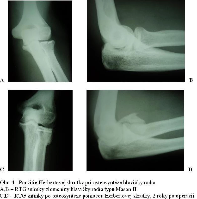 Použitie Herbertovej skrutky pri osteosyntéze hlavičky radia. A,B – RTG snímky zlomeniny hlavičky radia typu Mason II. C, D – RTG snímky po osteosyntéze pomocou Herbertovej skrutky, 2 roky po operácii