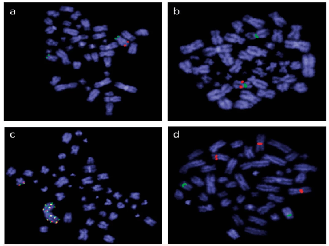 Výsledky screeningového vyšetření FISH při použití panelu sond pro detekci delece 5q, delece 7q, amplifikace KMT2A (MLL) a trizomie 8 (Abbott Molecular, USA) u nemocných s nově diagnostikovanou AML