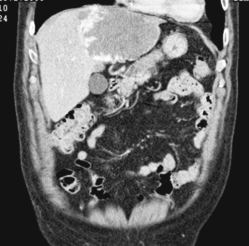 CT jater – hemangiom zaujímající levý lalok jater
Pic. 1. A CT view of the liver – hemangioma involving the left liver lobe