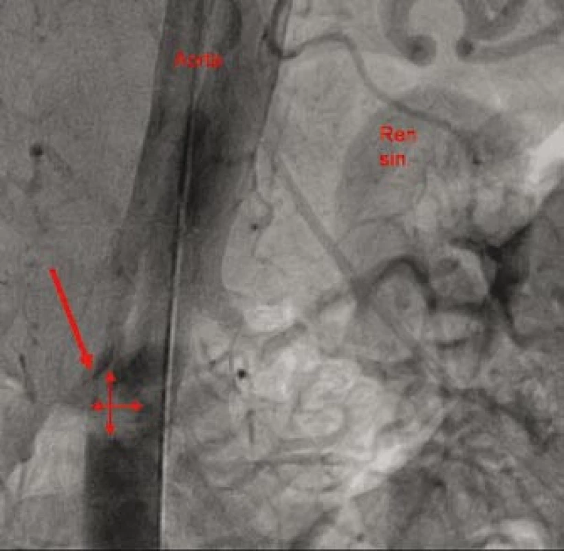 Nástěnný trombus v aortě infrarenálně.