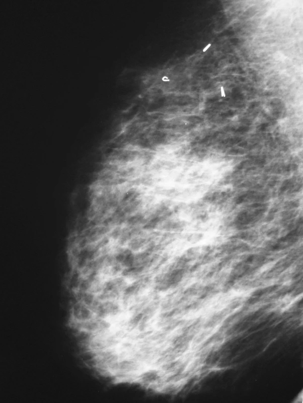 Mammografie po konzervativním výkonu
Pic. 4. Mammography after conservative surgery