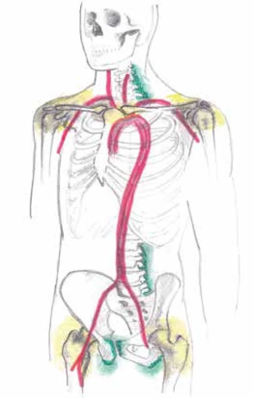 Znázornění postižení kloubních synoviálních struktur (glenohumerální a kyčelní klouby) žlutě, mimokloubních synoviálních struktur (subdeltoidní, subakromiální, trochanterické, iliopsoatické a interspinózní burzy obklopující spinózní výběžky krčních a bederních obratlů, oblast úponů hamstringů na hrbol sedací kosti) zeleně a vaskulitidu tepen velkého a středního kalibru červeně pomocí pozitronové emisní tomografie (PET) detekující radiofarmakum FDG u polymyalgia rheumatica a obrovskobuněčné arteriitidy. Otištěno s laskavým svolením prim. MUDr. Zdeňka Řeháka, Ph.D.