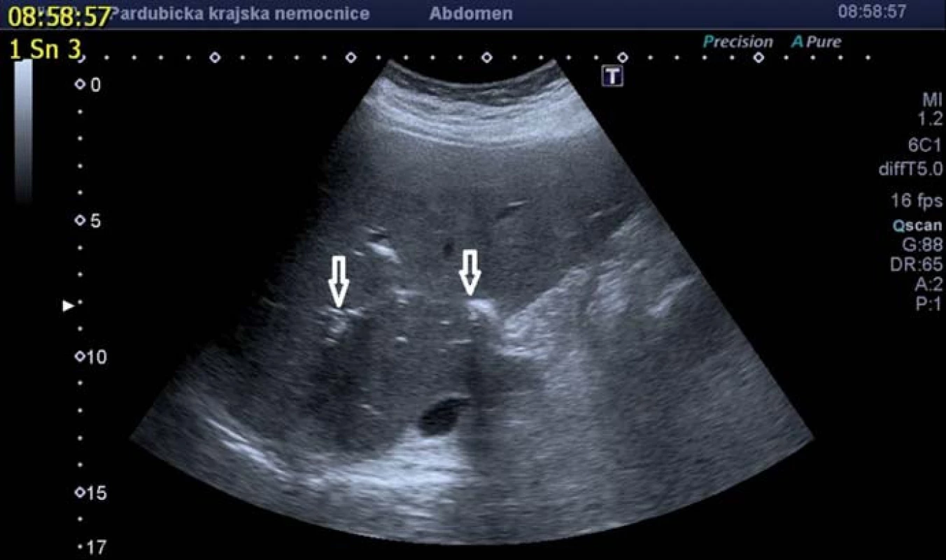 Pneumobilie při ultrazvukovém vyšetření.
Fig. 1. Ultrasound image of pneumobilia.