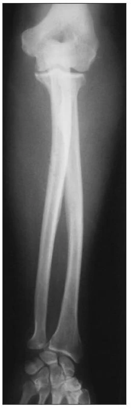 Predozadná RTG snímka ľavého predlaktia bezprostredne po úraze
Fig. 1. Anteroposterior radiograph of the left forearm immediately after injury